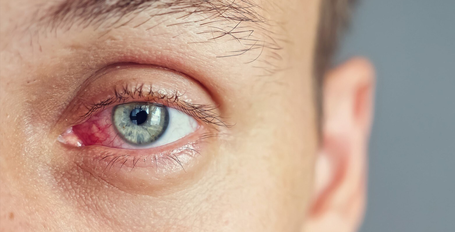 Alergia Ocular
