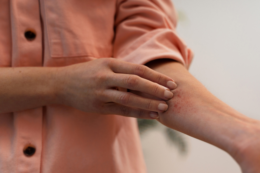 Dermatitis