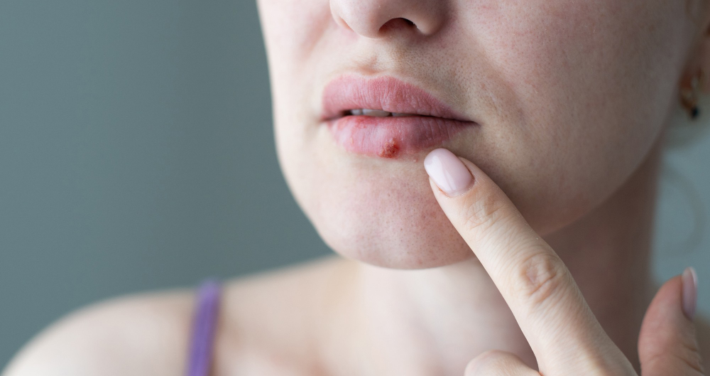 Herpes labial